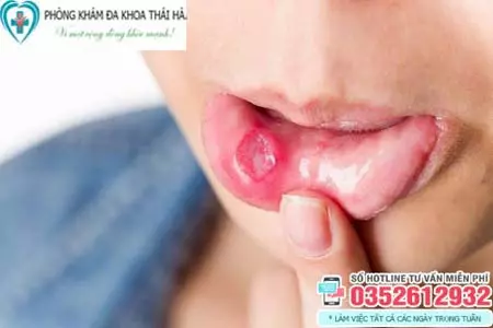 Hình ảnh bệnh giang mai ở miệng