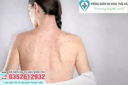 Triệu chứng bệnh giang mai ở nữ giới