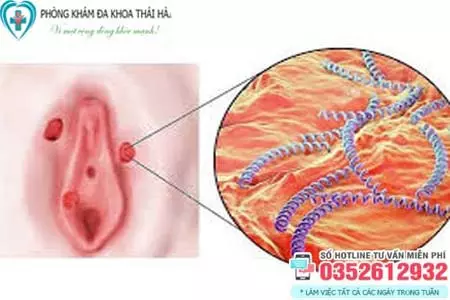 Hình ảnh bệnh giang mai ở bộ phận sinh dục nữ