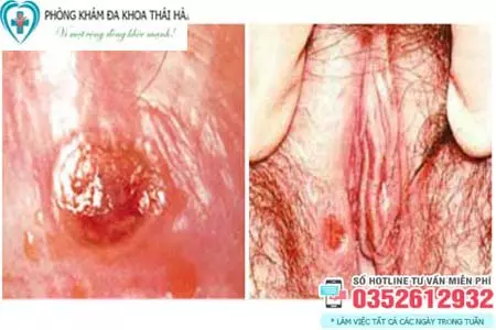 Hình ảnh bệnh giang mai ở vùng kín nữ