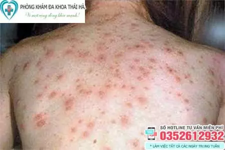 Hình ảnh bệnh giang mai ở phụ nữ
