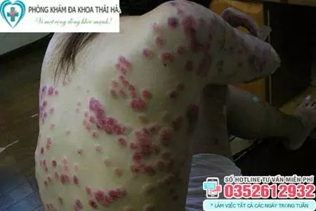 Hình ảnh bệnh giang mai ở nữ giới
