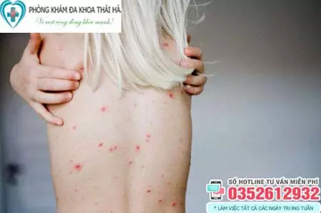 Hình ảnh bệnh giang mai ở nữ