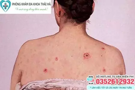 Hình ảnh bệnh giang mai ở nữ giới