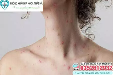 Hình ảnh bệnh giang mai ở nữ giới