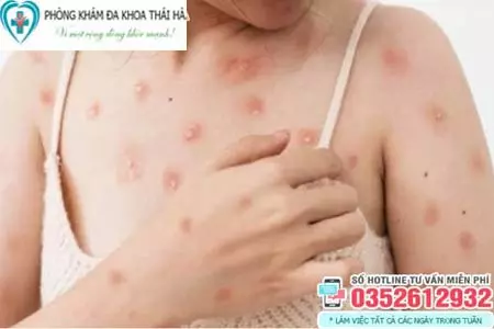 Hình ảnh bệnh giang mai ở nữ giới