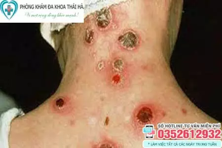 Bệnh giang mai ở nữ có nguy hiểm không