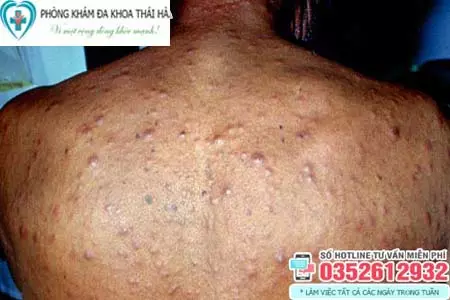 Bệnh giang mai có chữa khỏi được không