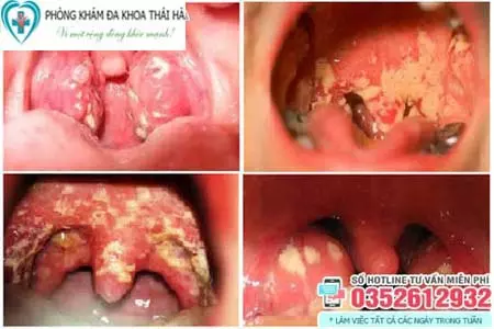 Triệu chứng bệnh lậu ở miệng, họng