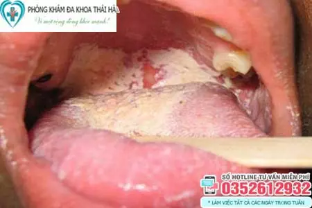 Dấu hiệu bệnh lậu ở miệng, họng