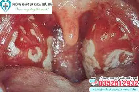 Hình ảnh bệnh lậu ở miệng