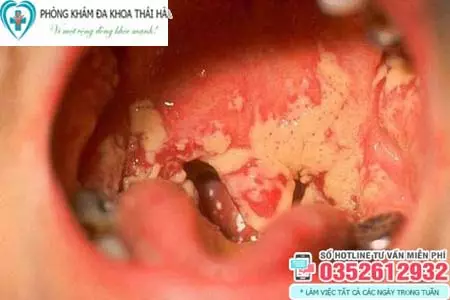 Hình ảnh bệnh lậu ở miệng, họng