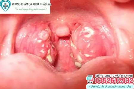 Cách chữa bệnh lậu ở miệng, họng
