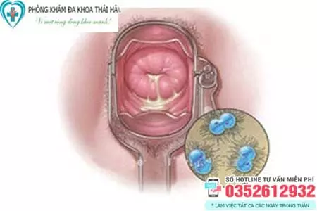 Triệu chứng bệnh lậu ở nữ giới