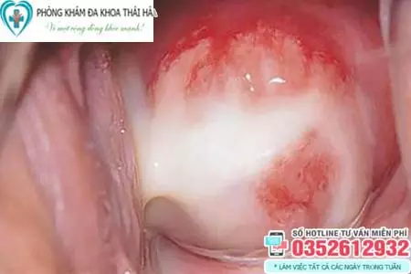 Hình ảnh bệnh lậu ở cổ tử cung phụ nữ