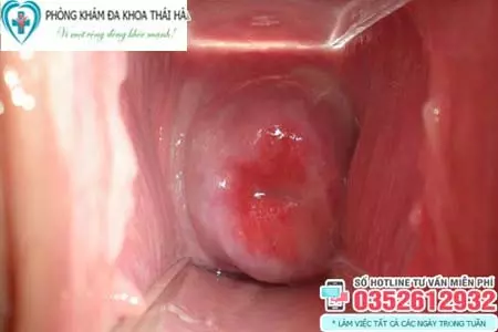 Hình ảnh bệnh lậu ở nữ