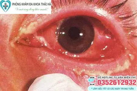 Hình ảnh bệnh lậu ở mắt nữ giới