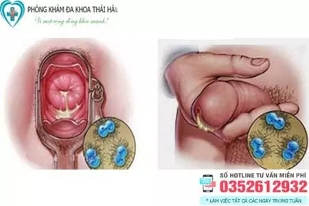 Bệnh lậu