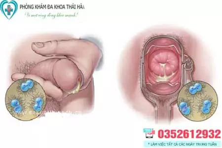 Hình ảnh bệnh lậu ở nam, nữ giới
