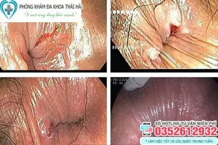 Hình ảnh bệnh lậu ở hậu môn