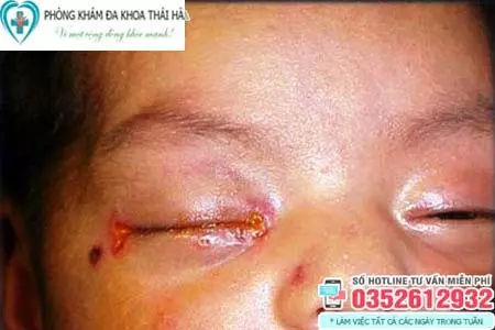 Hình ảnh bệnh lậu ở mắt trẻ em