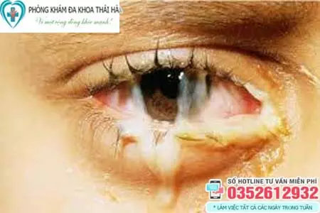 Hình ảnh bệnh lậu ở mắt nam giới