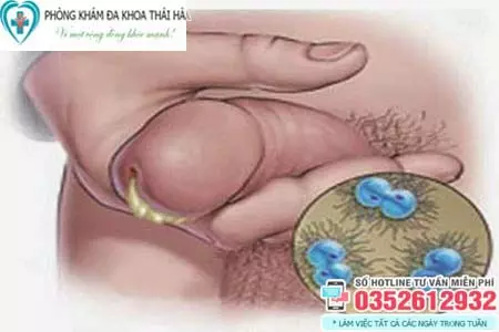 Triệu chứng bệnh lậu ở nam giới