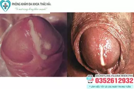 Hình ảnh về bệnh lậu ở nam giới