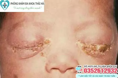 Hình ảnh bệnh lậu mắt ở trẻ sơ sinh
