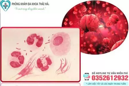 Chi phí chữa bệnh lậu