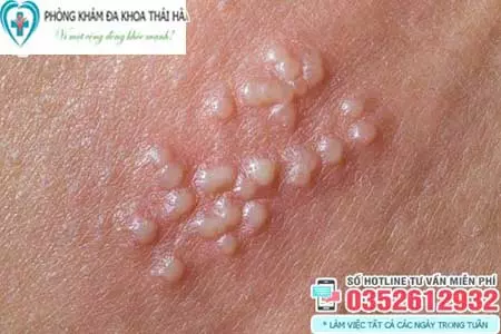 Cách chữa mụn rộp sinh dục