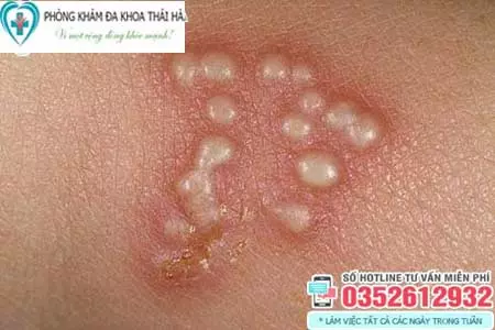 Mụn rộp sinh dục có nguy hiểm không