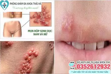 Triệu chứng mụn rộp sinh dục