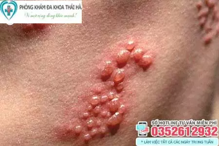 Mụn rộp sinh dục