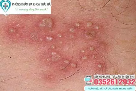 Hình ảnh mụn rộp sinh dục