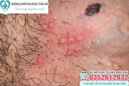Hình ảnh mụn rộp sinh dục nam