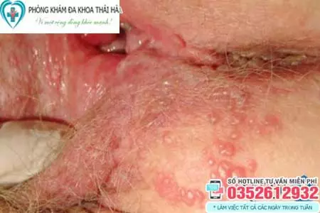 Hình ảnh mụn rộp sinh dục nữ