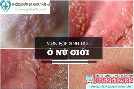 Mụn rộp sinh dục ở nữ giới