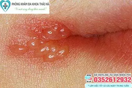 Hình ảnh mụn rộp sinh dục ở miệng