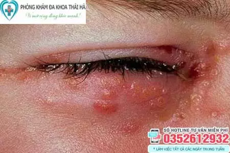 Hình ảnh mụn rộp sinh dục ở mắt
