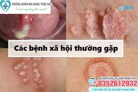 Các bệnh xã hội và triệu chứng thường gặp