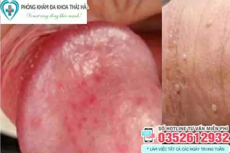 Đầu dương vật nổi mẩn đỏ