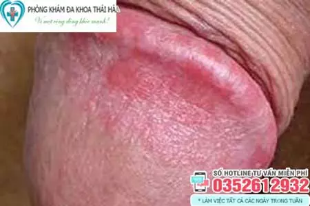Dương vật nổi mẩn đỏ có sao không