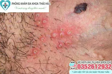 Hình ảnh nổi mụn bọc ở thân dương
