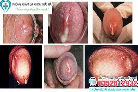 Dương vật chảy mủ trắng đục là bệnh gì