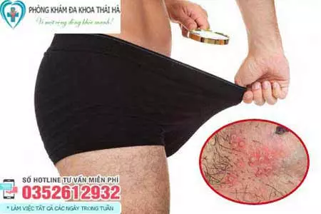 Thân dương vật nổi mụn gây ngứa là bị gì