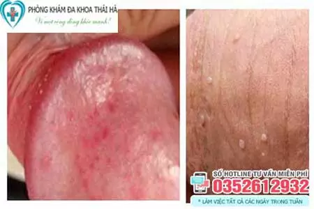 Dương vật nổi mụn đỏ ngứa do viêm bao quy đầu