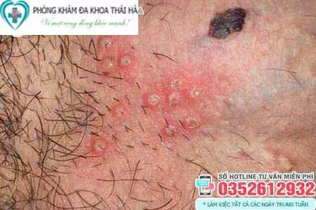 Dương vật nổi mụn ngứa do bệnh mụn rộp