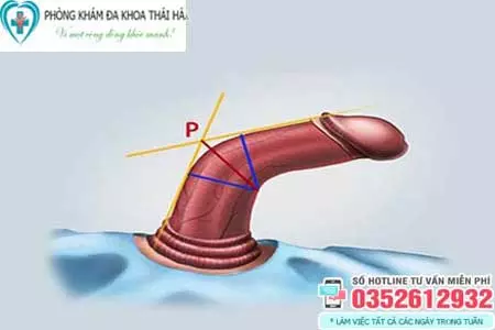 Dương vật bị lệch có sao không
