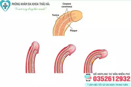 Dương vật bị cong phải làm sao